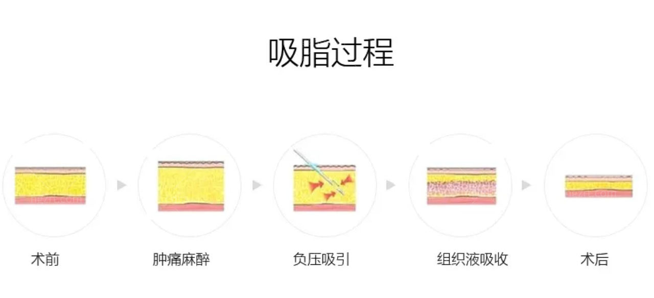 最新吸脂技术，重塑身材的革命性突破