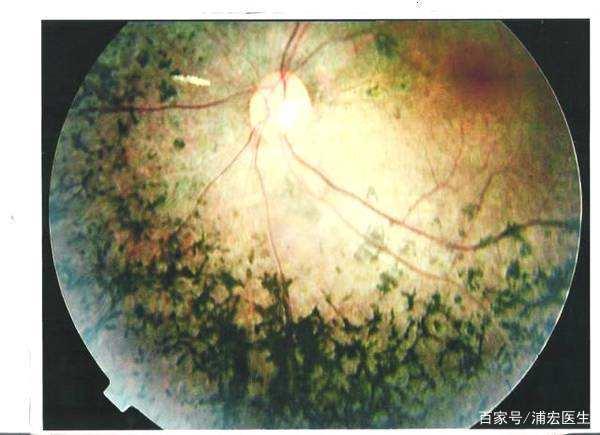 视网膜色素变性最新研究进展与前沿治疗方法探索