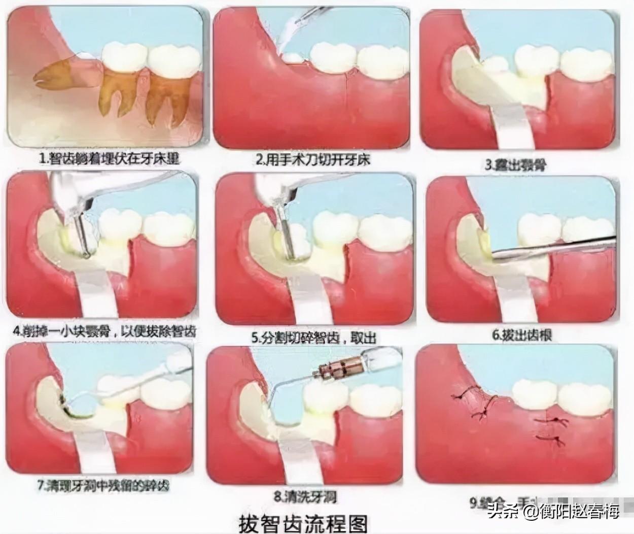 革新口腔医疗，最新拔智齿技术引领行业新潮流