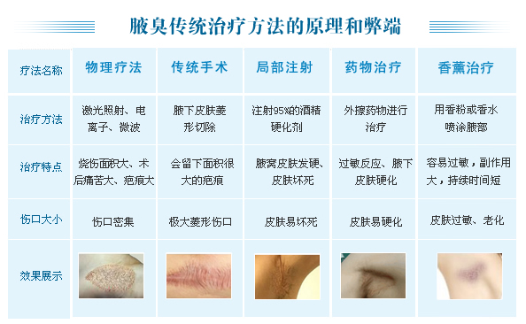 腋臭最新研究及治疗进展概述